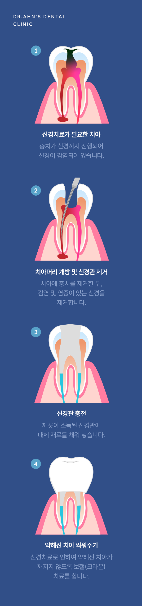 안치과 신경치료 과정