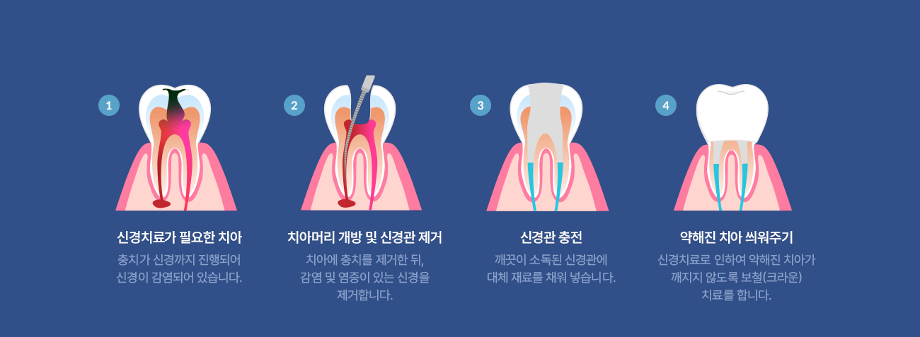 안치과 신경치료 과정